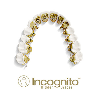 Straighten Your Teeth Invisibly with Lingual Braces - Belmar Orthodontics