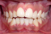 Patient's teeth before orthodontic treatment, front view
