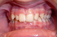 Patient's teeth before orthodontic treatment, front view