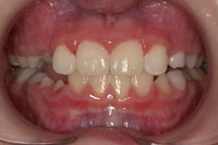 Patient's teeth after orthodontic treatment, front view