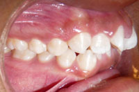 Patient's teeth before orthodontic treatment, side view