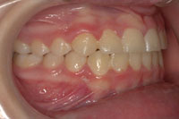 Patient's teeth after orthodontic treatment, side view