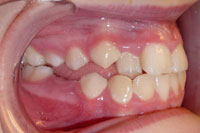 Patient's teeth before orthodontic treatment, side view