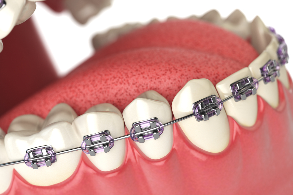 High-Tech Alloy Dental Wires