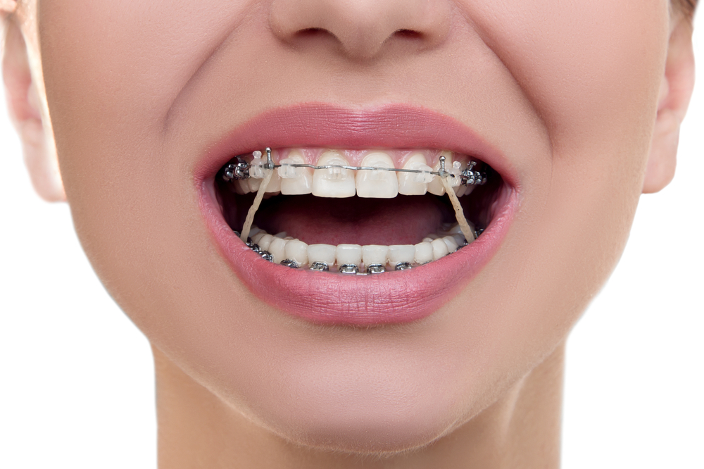 How Orthodontic Elastic Bands Work Belmar Orthodontics
