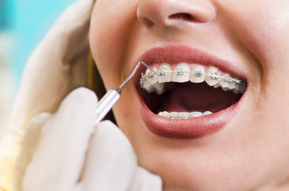 Why You Need Professional Orthodontic Care - Belmar Orthodontics