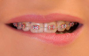 close up of braces