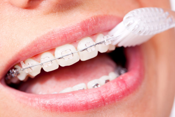 Cavity Treatment During Braces Belmar Orthodontics 