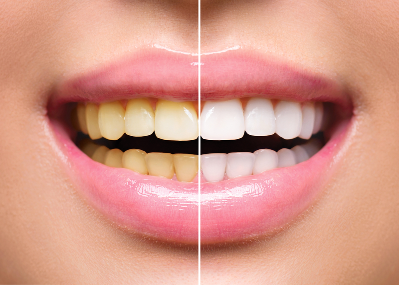 Close-up image of a person's teeth before and after teeth whitening