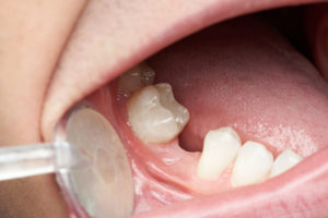 Close-up view of an area of a patient's mouth that has had a tooth knocked out