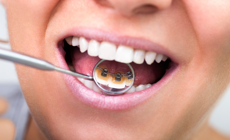 View of a dental mirror showing the camera that a patient has lingual braces behind their teeth.