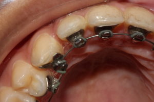 What Advantages Do Lingual Braces Have Over Traditional? - Hardy