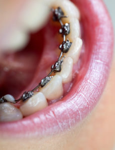Close-up view of the inside of a patient's mouth with lingual braces on the teeth.