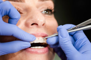 Close-up view of a woman with clear braces on her teeth that are being adjusted by an orthodontic professional.