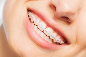 A close-up view of a person's mouth that has ceramic braces on the teeth.
