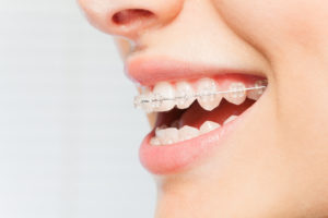 A close-up view of a person's smile that has clear, ceramic braces on the teeth.