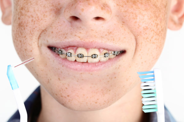 Rubber Bands And Braces Belmar Orthodontics 