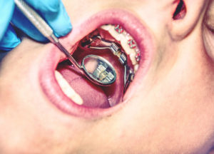 Patient with dental expander in mouth being treated by dentist