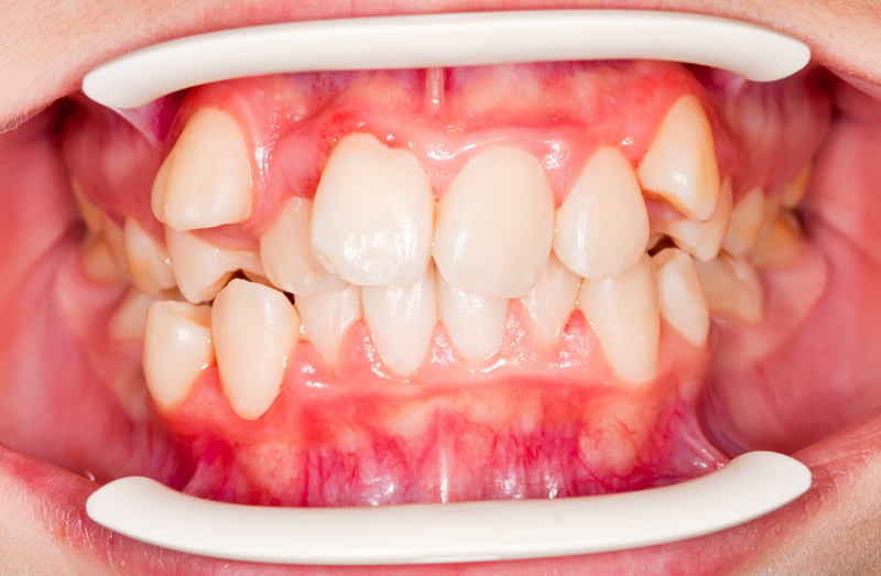 Closeup of crowded teeth in dental patient's mouth