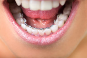 Up close photo of woman's mouth with lingual braces