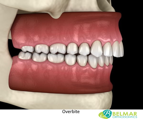 Sikker det samme Installation Overbite Teeth: What is an overbite or Buck Teeth?, Treatment, Causes and  Symptoms | Belmar Orthodontics